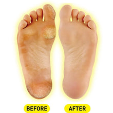 Load image into Gallery viewer, PROFOOT Callus Blaster Gel Callus Remover